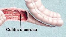 colitis_ulcerosa_1.jpg